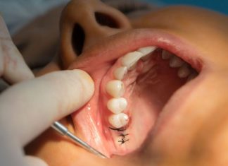 Chirurgie-dentoalveolara